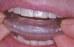 Le grincement des dents : le bruxisme - Dentalespace