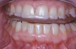 Le grincement des dents : le bruxisme - Dentalespace