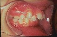 Dents déformées et sucette : tout savoir sur les effets de la tétine -  Dentiste pour Enfants