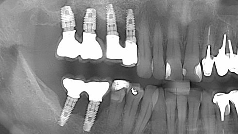 péri-implantite 