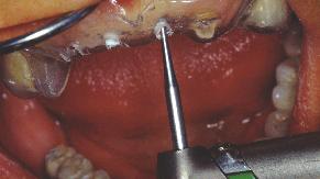 Restauration antérieure implantaire : Le continuum chirurgico