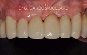 Fig. 4 : résultat final où le bridge sert à la fois de moyen de remplacement de la dent manquante, de restauration des dents voisines et de contention parodontale.