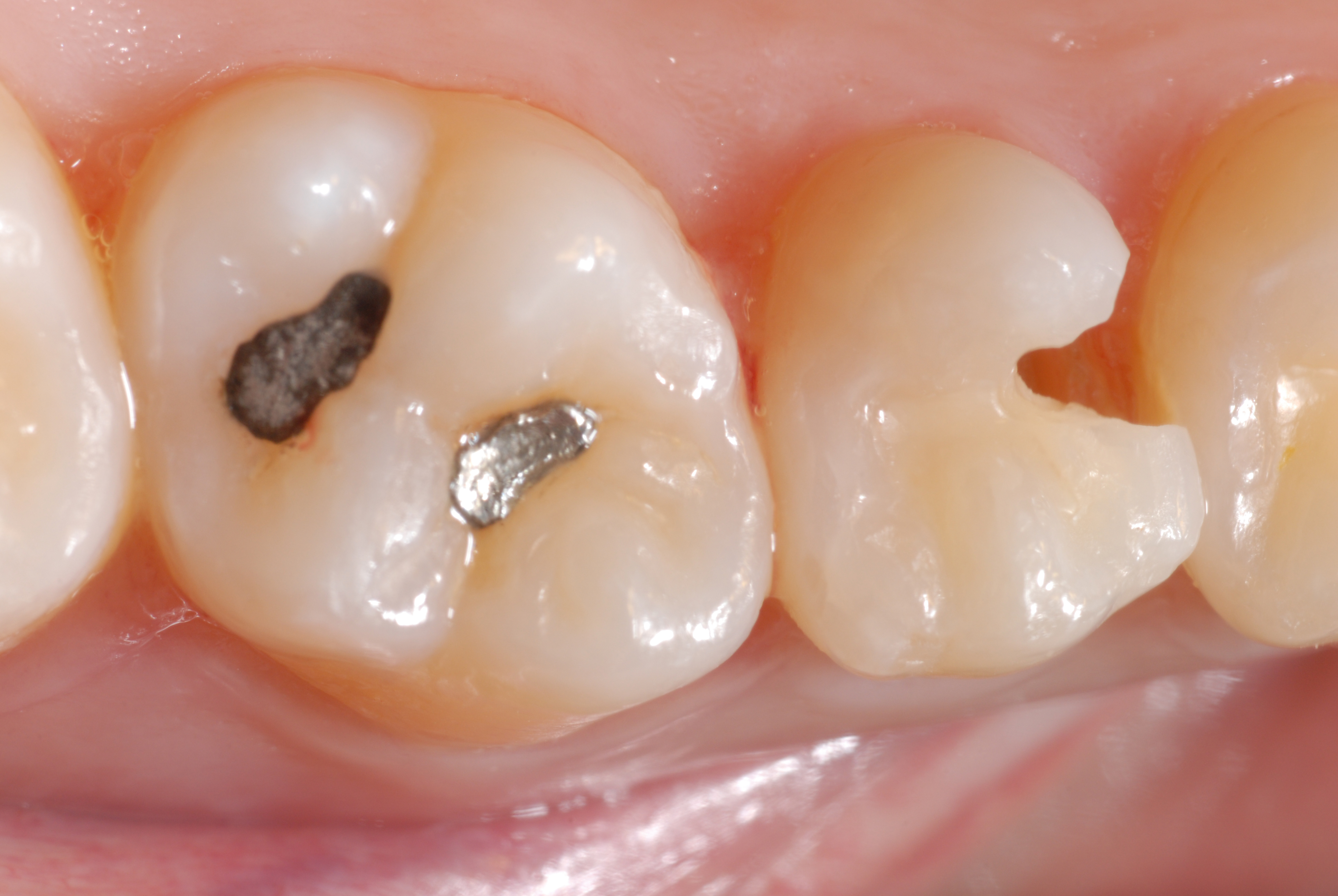 Ill. 1 : Obturation de la dent 15 suite à une lésion carieuse, et de la dent 16 pour des raisons esthétiques 