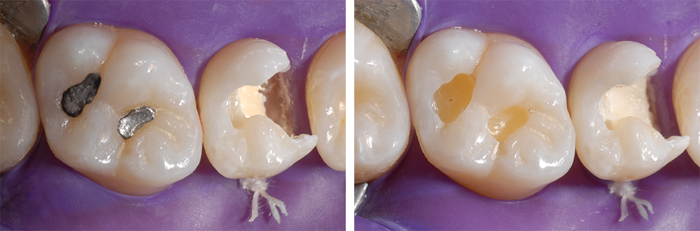Ill. 4 et 5 : Protection du complexe pulpe-dentine avec de l'hydroxyde de calcium sous forme de pâte et un fond de cavité en ciment verre ionomère (IonoStar Molar de VOCO) Les cavités préparées de la classe I sur la dent 16