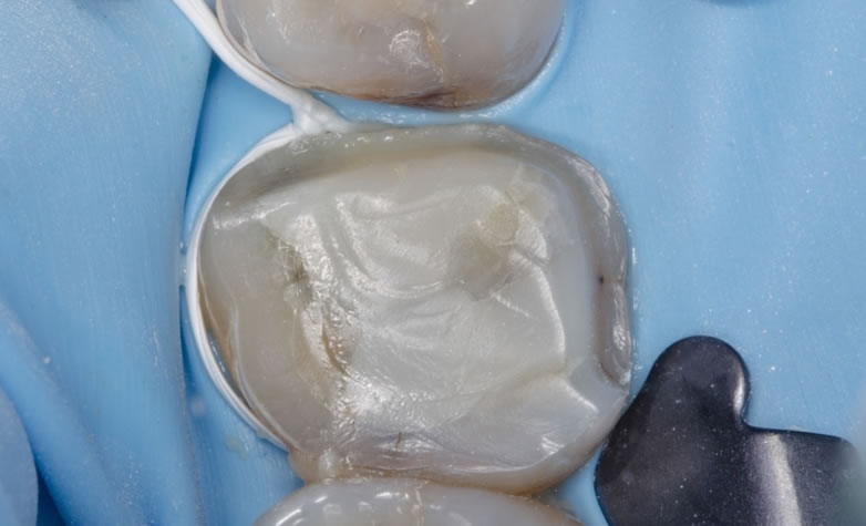 Ligature mise en place qui cercle la dent préparée