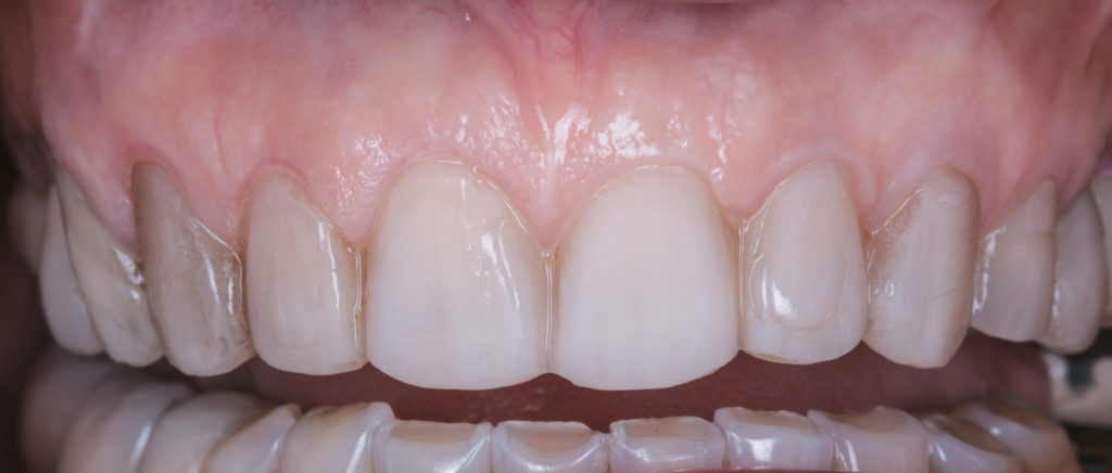 Résultat esthétique d’un traitement dentaire complexe