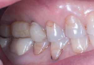 Résultat esthétique d’un traitement dentaire complexe