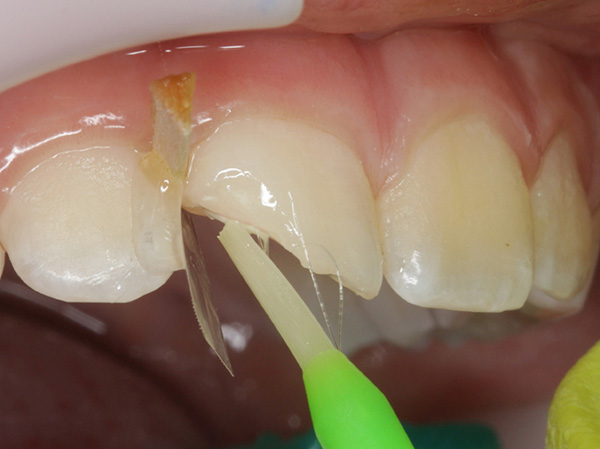 Ill. 6 : Nous appliquons un adhésif universel (Futurabond U) sur l'émail et la dentine avant de le durcir.