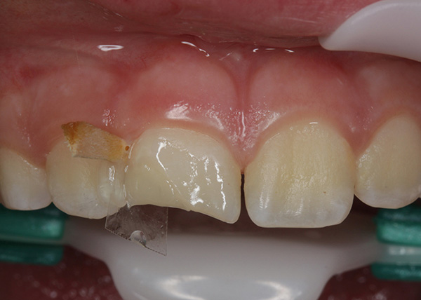 Ill. 7 : Situation après reconstitution du noyau de dentine avec un matériau d'obturation à base de céramique en teintes A2 et A3 : la reconstitution a été réalisée en deux couches afin de mieux pouvoir évaluer les dimensions en cours d'intervention.