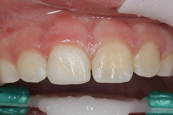 Ill. 11 : En raison du dessèchement, la dent 11 traitée semble légèrement plus claire que la dent controlatérale 21.