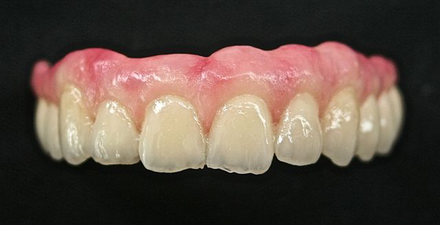 Photo 4 : Stratification gencive et dents en céramique d’un all on six sur MUA. Travaux du laboratoire DECHE.