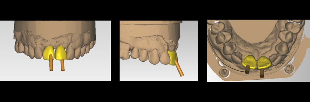 Photo7 : Mise en évidence des axes implantaires (logiciel DTX Studio Design)