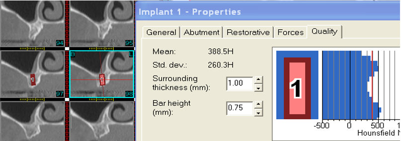 Position idéal d’un implant en position 16 dans l’axe prothétique : l’implant est de 3,5x 10 mm avec une densité osseuse périphérique moyenne de 388 unités Hounsfield.