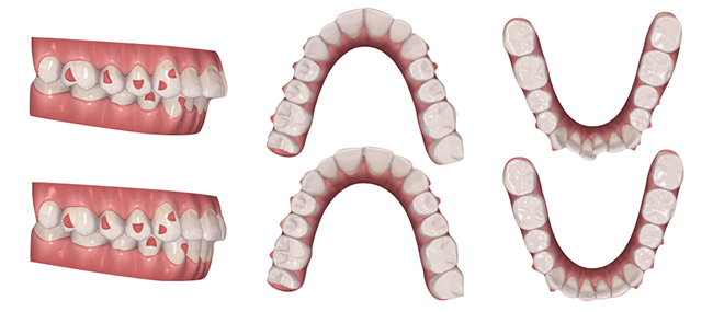 Fig. 12 : Set up orthodontique afin de prévisualiser le résultat 
