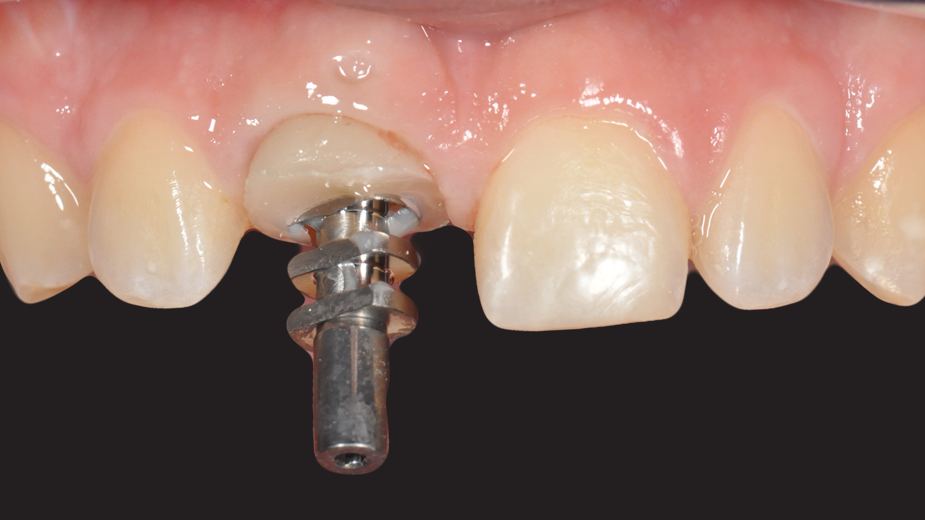 Extraction implantation et temporisation immédiate sur les dents unitaires  antérieures : 10 ans de recul clinique