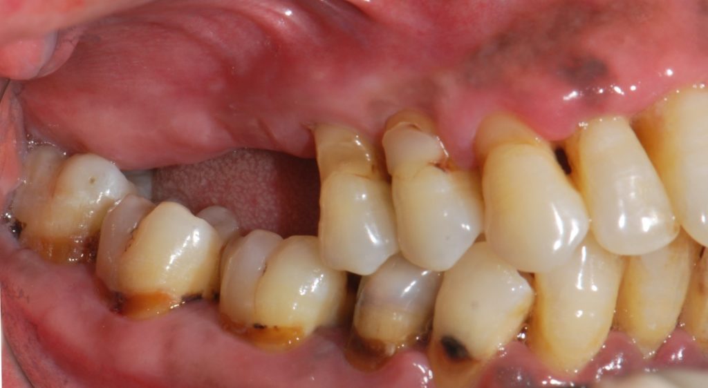 Photo 2 – Caries cervicales, soins iatrogènes, inflammation gingivale