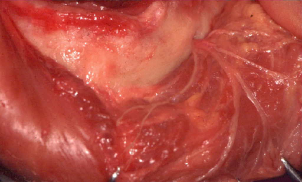 Fig 3 : Dissection anatomique de l'arborescence d'un foramen mentonnier