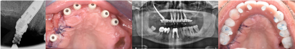 Fig 8 : Cas clinique 3 : Rescue implant : rattrapage d'un implant distal non ostéintégré par un implant zygomatique et reconnection dans la séance à l'armature titane du bridge d'usage (soudure laser)