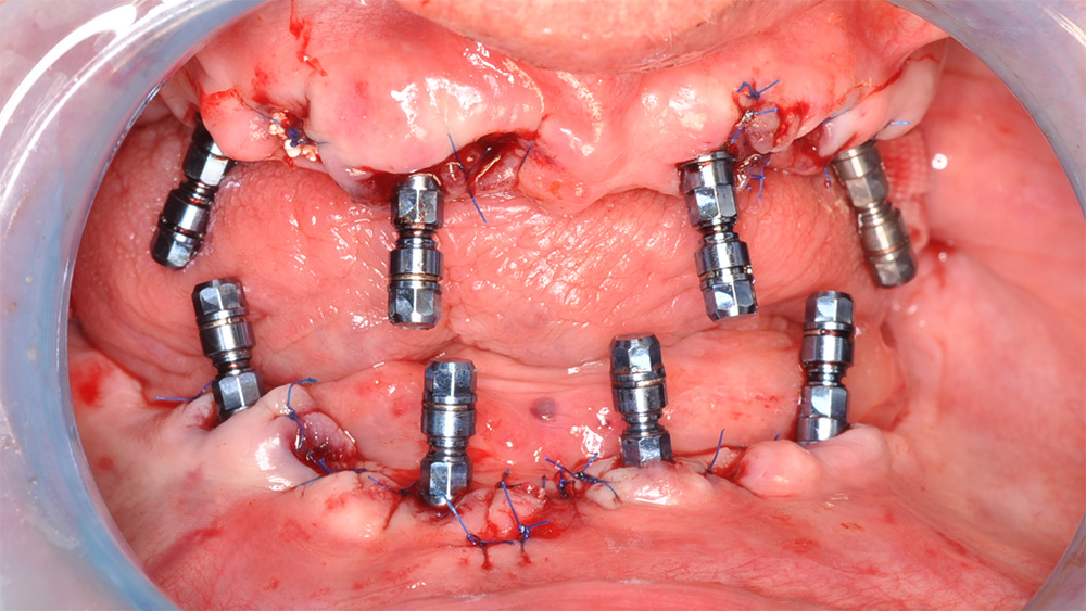 Pose de 8 implants TL STRAUMANN sous anesthésie générale
