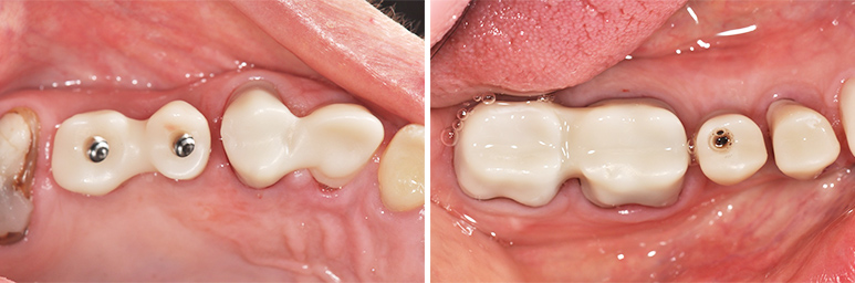 Fig. 10a : Restauration du secteur maxillaire droit. Étapes d’essayage. Fig. 10b : Restauration du secteur mandibulaire droit. Etapes d’essayage.