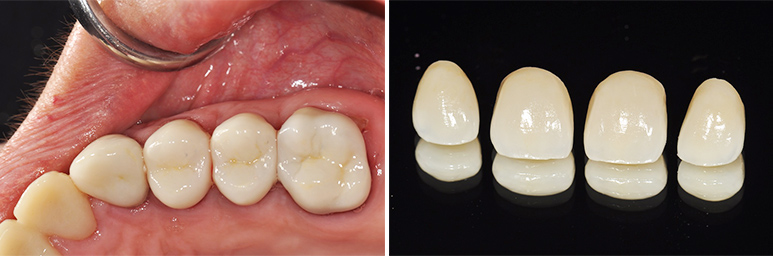 Fig. 10e : Restaurations d'usage du secteur maxillaire gauche. Fig. 10f : Couronnes périphériques céramo-céramiques du secteur antérieur maxillaire.