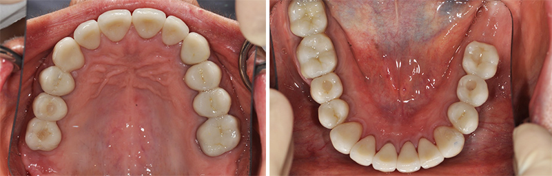 Fig. 11c : Restauration finale, vue occlusale maxillaire. Fig. 11d : Restauration finale, vue occlusale mandibulaire.