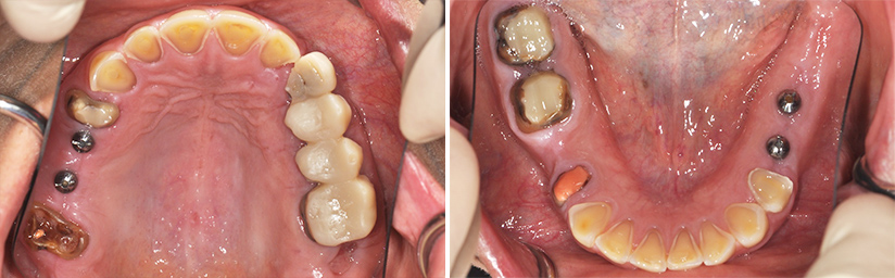 Fig. 6a : Vue occlusale de l’arcade maxillaire après traitements pré-prothétiques. Fig. 6b : Vue occlusale de l’arcade mandibulaire après traitements pré-prothétiques.