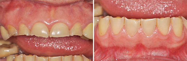 Fig. 7a : Détail de l’usure dentaire sur les dents antérieures maxillaires. Fig. 7b : Détail de l’usure dentaire sur les dents antérieures mandibulaires.