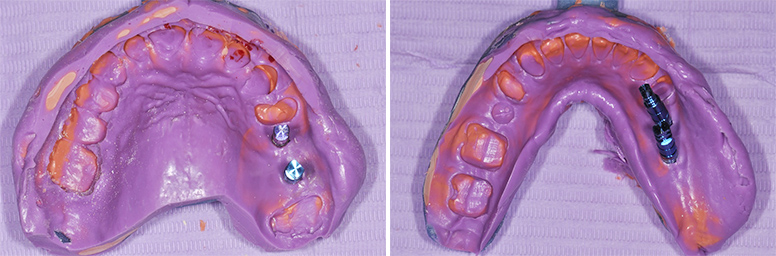 Fig. 8a et 8b : empreintes implantaires globales.