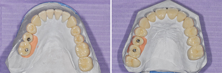 Fig. 8d et 8e : Fabrication au laboratoire des restaurations transitoires dento- et implanto-portées.