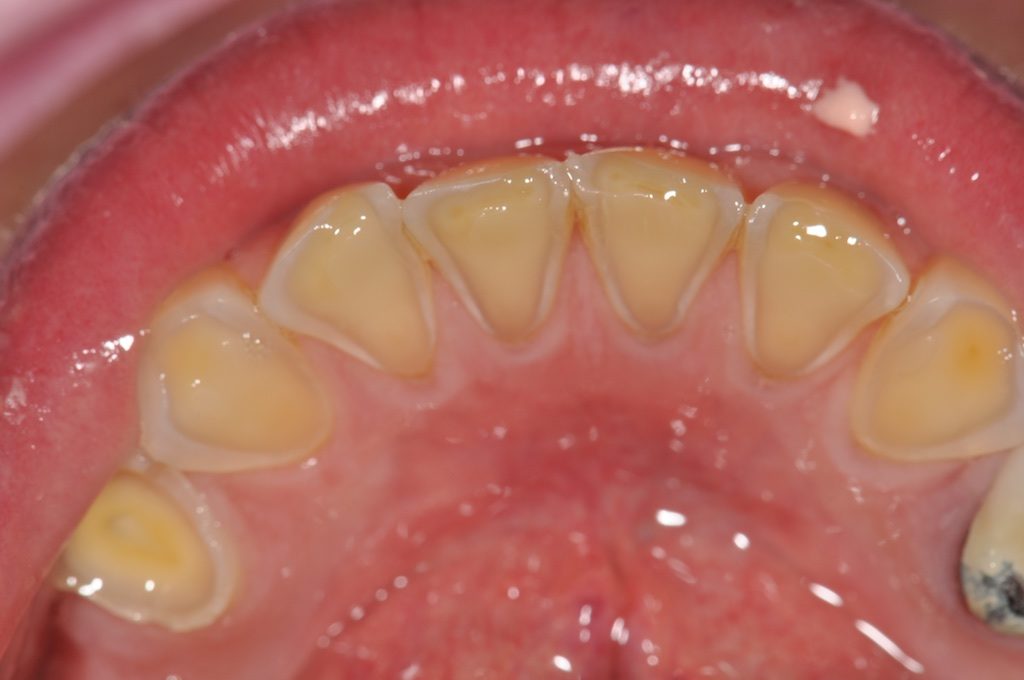 Fig. 4 : Détail des zones d’érosion des faces linguales des dents antérieures mandibulaires.