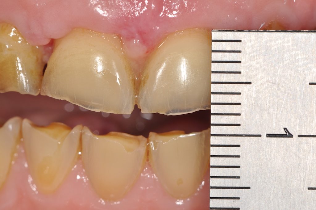 Fig. 8c : Mesure de la longueur des couronnes cliniques pour la communication au laboratoire de la position du futur bord libre des incisives maxillaires.