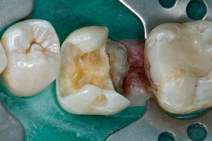 Ill. 3 : Isolation de la zone de traitement avec une digue appliquée dans le secteur des dents 46 et 47 au moyen de la technique à perforation allongée.