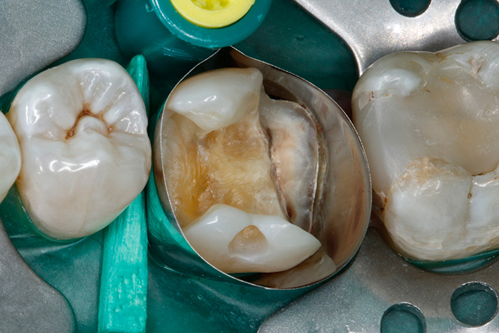 Ill. 4 : Délimitation du défect dentaire à l'aide d'une matrice métallique circulaire.