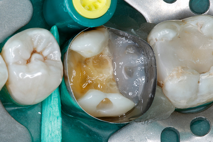 Ill. 15 : La barre composite, qui fixe la situation prétendue, est nettement visible au niveau du fond de la cavité distal, compensant ainsi l'épaisseur de la couche matricielle et garantissant des contacts étroits avec les dents adjacentes.