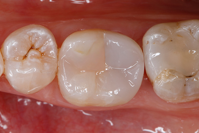 Ill. 18 : Situation finale : poli spéculaire de la restauration composite « bulk fill » avec reconstitution des cuspides terminée. La fonction et l'aspect esthétique de la dent sont rétablis.