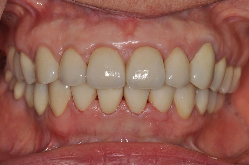 Jusqu'à 62% 1 ou 2 protège-dents pour la prévention de l'usure des dents