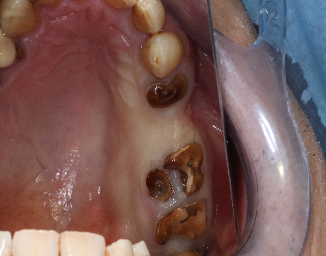 Fig 01 : Vue préopératoire : parodonte épais et large, tissu kératinisé sont autant de points favorables à la stabilisation osseuse péri-implantaire.