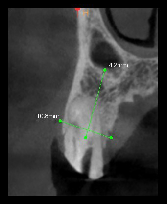 Site du l’implant 14 : paroi osseuse vestibulaire, hauteur pour ancrage apical, diamètre de l’implant