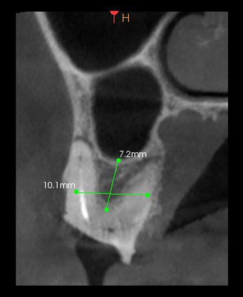 Site implant 16-17 : le futur implant sera stabilisé par la largeur de son diamètre, il y a suffisamment de hauteur pour poser un implant, présence de paroi vestibulaire, le défaut osseux sera facilement comblé.