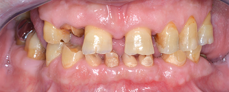 Place de la gouttière occlusale dans la prise en charge globale des  dysfonctionnements temporo-mandibulaires – L'Information Dentaire