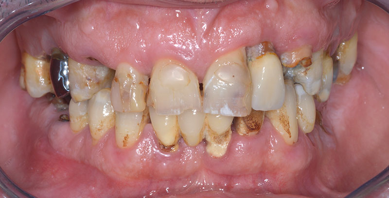 Place de la gouttière occlusale dans la prise en charge globale des  dysfonctionnements temporo-mandibulaires – L'Information Dentaire