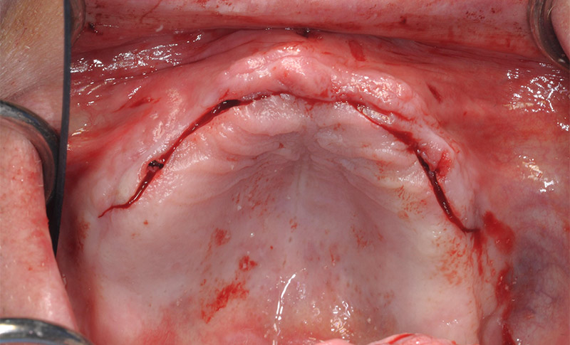 Fig-10-incision crestale