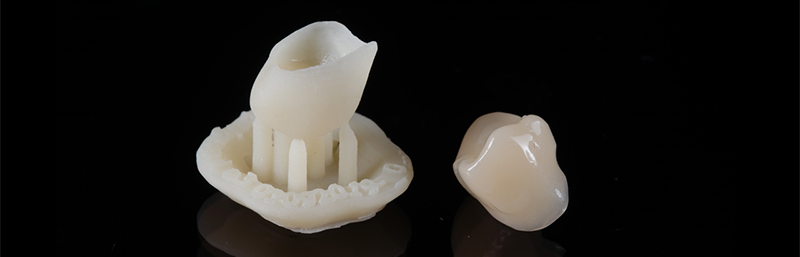 Prothese-provisoire-Imprimante-3D-Lanoiselée