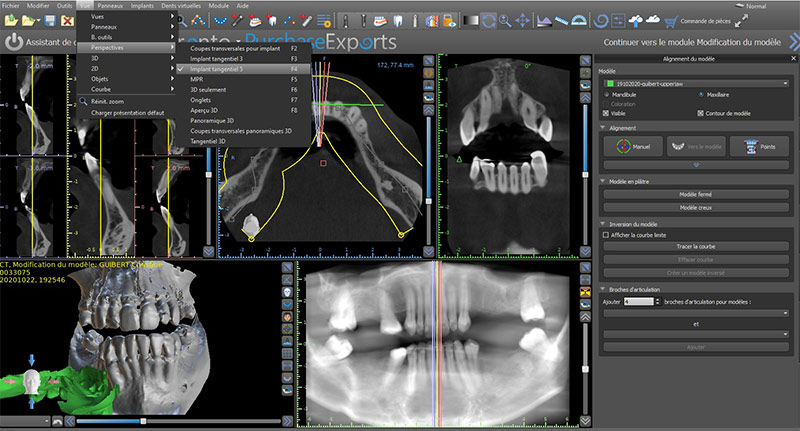 Formation-Boccara-Perspective-Implant-Tangenciel