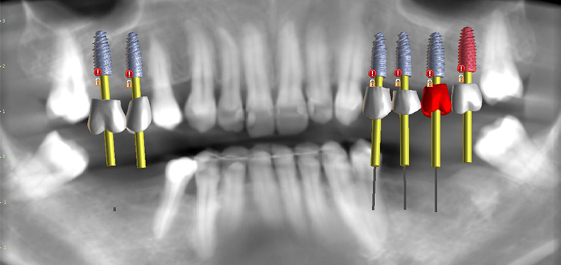 Formation-Boccara-Vue-panoramique-dents-implants