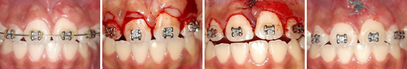 Gingivectomie-frenectomie