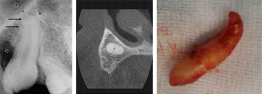 Canine-Inclusive-Maxillaire-Malformations-dentaires