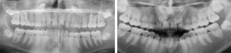 Image-canine-inclusive-maxillaire-Ablation-chirurgicale