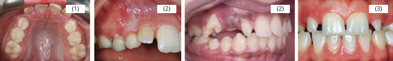 Image-canine-inclusive-maxillaire-Diagnostic